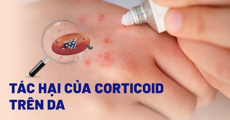 tac-hai-cua-corticoid-tren-da