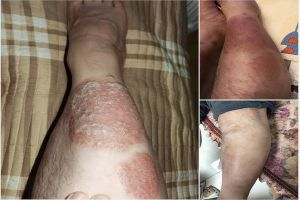 Anh Tùng chia sẻ :Căn bệnh vảy nến quái ác