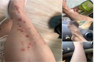 Bệnh Nhân Hoài Anh 26 tuổi ở Hà Nội bị căn bệnh vảy nến cũng gần 1 năm nay.