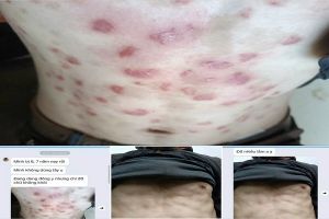 Anh Nam - 42 tuổi bị vảy nến toàn thân hơn 6 năm nay, anh bị khá nặng
