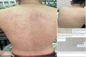 Em Quý, 27 tuổi, từng khổ sở vì viêm da nổi mẩn ngứa kéo dài nhiều tháng