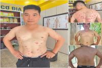 Anh Trường , 35 tuổi bị vảy nến nặng suốt 5 năm