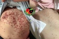 Bé Đại 12 tuổi ở Thanh Hóa bị tình trạng vảy nến thể giọt 5 năm. 