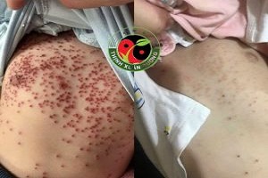 Bé Đại 12 tuổi ở Thanh Hóa bị tình trạng vảy nến thể giọt 5 năm. 