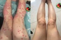 Chị Hà ở Hà Nội bị vảy nến 4 năm sau 3 tháng điều trị