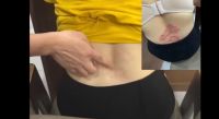 Video thăm khám bệnh nhân vảy nến Thịnh Xuân Đường