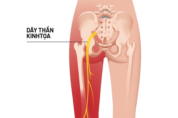 Đau thần kinh tọa