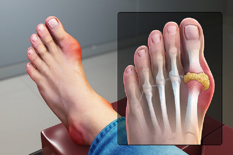 Bệnh Gout