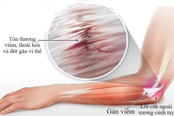 Viêm điểm bám gân