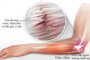 Viêm điểm bám gân