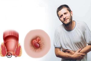 Trĩ là gì - Điều trị đông y như thế nào