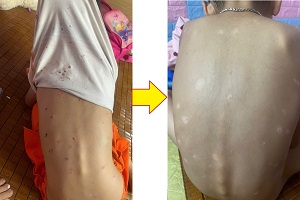 Bé trai 6 tuổi ở Nghệ An sau 2 tuần điều trị vảy nến