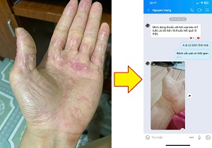 Bệnh nhân á sừng sau 1 tuần điều trị tại Thịnh Xuân Đường