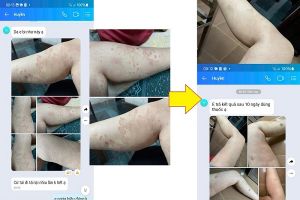 Bệnh nhân bị biến chứng Hắc lào nặng sau 10 ngày điều trị