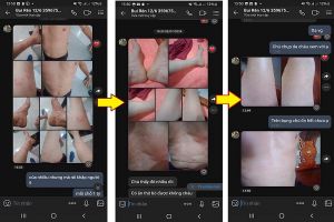 Bé trai 12 tuổi sau 2 tháng điều trị bệnh vảy nến tại PK Thịnh Xuân Đường
