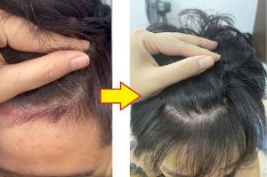 Bệnh nhân vảy nến da đầu sau 10 ngày điều trị phòng khám YHCT Thịnh Xuân Đường